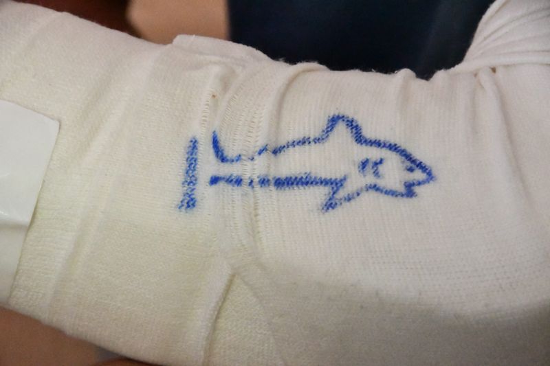 Floridana Beach surfer Teddy WittemannÕs bandage from his shark bite is adorned with a hand drawn shark. His friend Kaia Anderson, who was also bitten by a shark at Floridana Beach in 2017, stopped by and added the artwork to his bandage.
