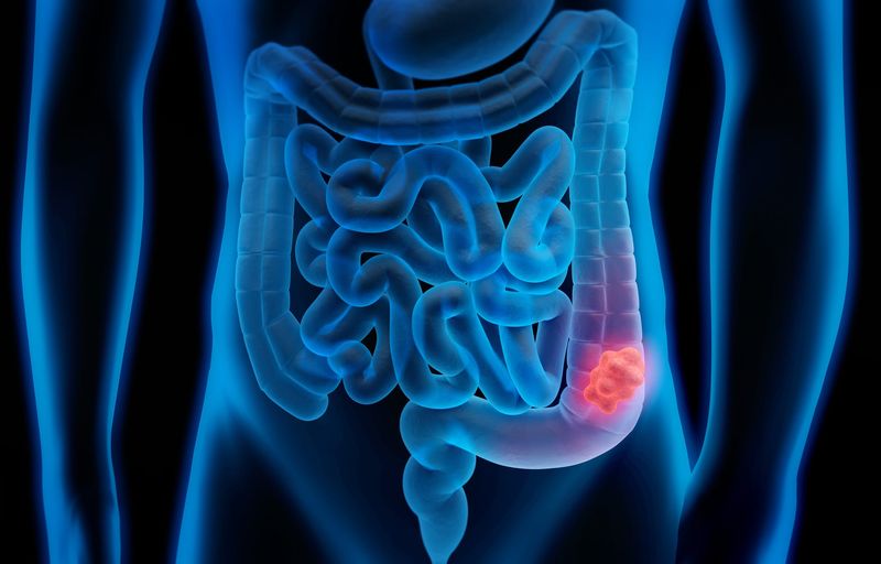 Colorectal cancer is a type of cancer that develops in the colon or rectum, from the large intestine to just before the anus.