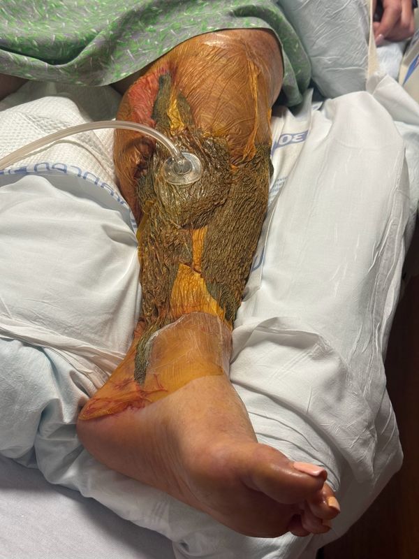 Genevieve Gallagher was infected with vibrio vulnificus after swimming in Santa Rosa Sound off Pensacola Beach, on July 27. She has undergone several surgeries to save her leg and her life. She is currently hospitalized at UF Health Shands Hospital.