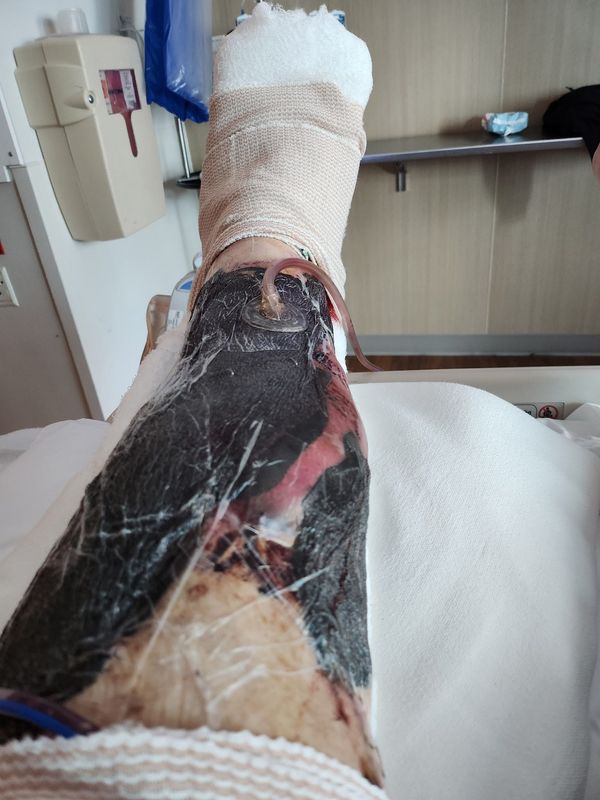 Genevieve Gallagher has had multiple surgeries to save her leg after she contracted vibrio vulnificus bacteria. She was infected after swimming in Santa Rosa Sound off Pensacola Beach on July 27. This picture of her leg was taken Sept. 2, as she prepares for another surgery.