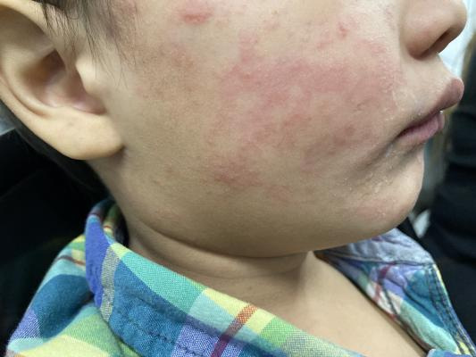 A rash on the cheek of a child infected with measles during a 2024 U.S. outbreak.