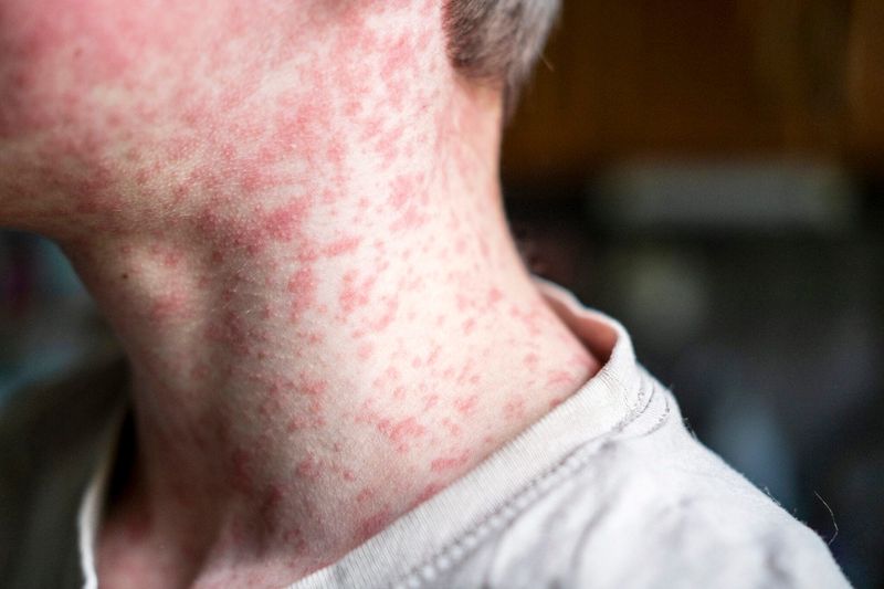 Measles begins with a blotchy red rash that typically appears on the face and then spreads to the body of the person infected.