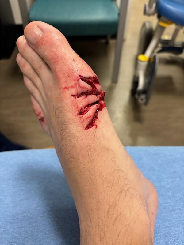 Brian Miller was bitten by a shark on his left foot when he took a dip in the ocean while paddleboarding off Flagler Beach near 17th Street South on Saturday, April 25, 2026.