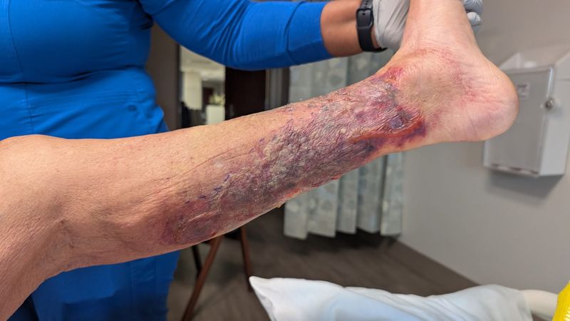 Albert Allison contracted Vibrio vulnificus while fishing on a dock in East Naples on Aug. 31, 2025. This shows the improvement after three antibiotics and wound treatment at NCH Baker Hospital on Sept. 8.