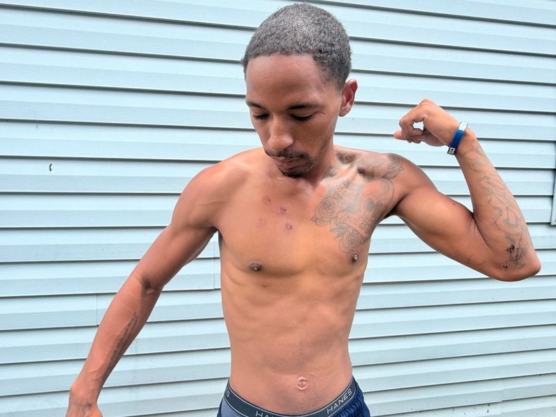 Devin Hunt, 25, shows his wounds healing four days after he was shot with a less-lethal pepper ball gun by an Indianapolis Metropolitan Police Department officer downtown on June 15, 2025.