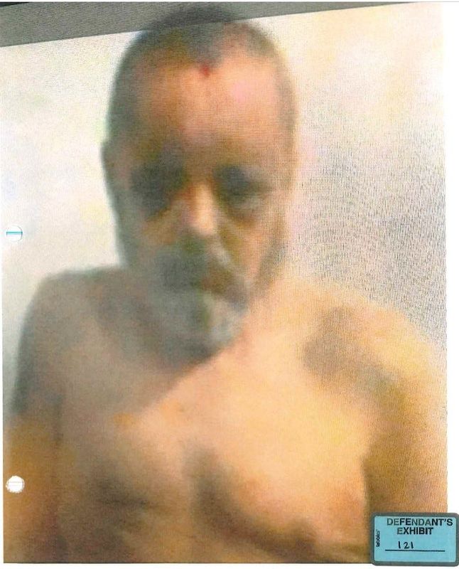 This blurry photo purports to show Delphi murder suspect Richard Allen after suffering trauma to his face while in pretrial safekeeping detention at Westville prison. It was included in the 1,201 pages of exhibits filed Monday, Nov. 10, 2025.