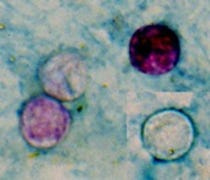 Four Cyclospora oocysts from fresh stool stained using a modified acid-fast stain.