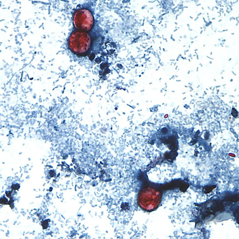 The Ionia County Health Department has identified six confirmed cases and two suspected cases of cyclosporiasis.