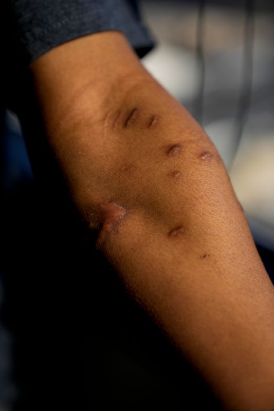 "Richard” shows the scars left by the bite from a police dog at Friday, Feb. 20, 2026.