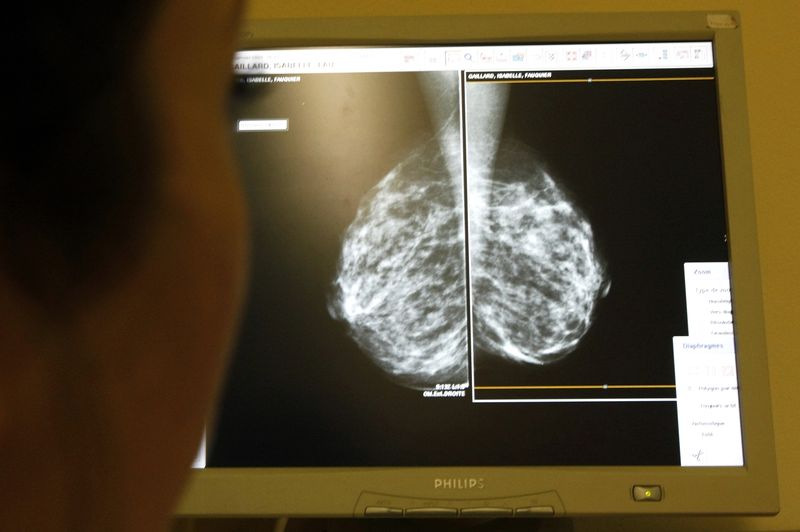 FILE PHOTO: A doctor exams mammograms in Nice, south eastern France January 4, 2008. REUTERS/Eric Gaillard/File Photo