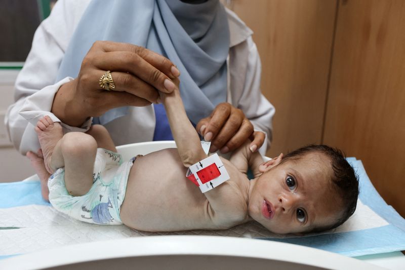 A nurse examines a malnourished child, according to medics, at Nasser Hospital in Khan Younis, southern Gaza Strip, July 25, 2025. REUTERS/Ramadan Abed