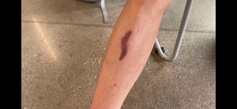 Jordan Stolz has a scar after a 16-stitch cut over the summer from a fall off his bike.