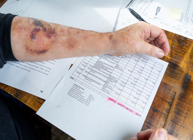 Chemotherapy-related bruising is visible on Scot Meisenheimer’s arm.